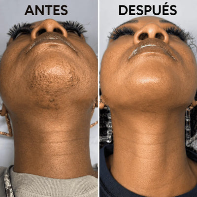 Detiene el crecimiento del vello de forma natural