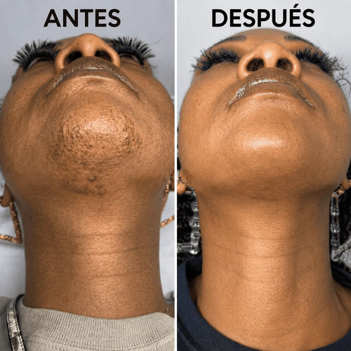 Detiene el crecimiento del vello de forma natural