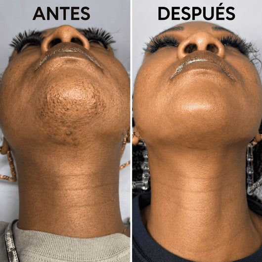 Detiene el crecimiento del vello de forma natural