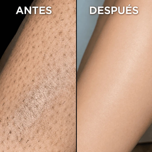 Detiene el crecimiento del vello de forma natural